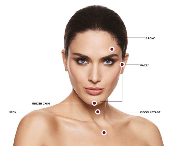 Ultherapy and HIFU treatment areas: brow, face, under chin, neck, decolletage